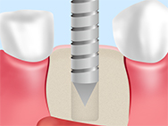 STEP3： インプラント埋入