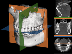 歯科用CTの三次元立体画像