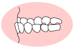 反対咬合（はんたいこうごう） 