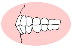 上顎前突（じょうがくぜんとつ）