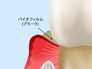 軽度歯周病