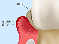 中等度歯周病